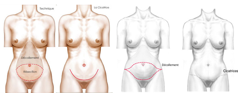 Chirurgie Plastique de l'Abdomen à Lyon