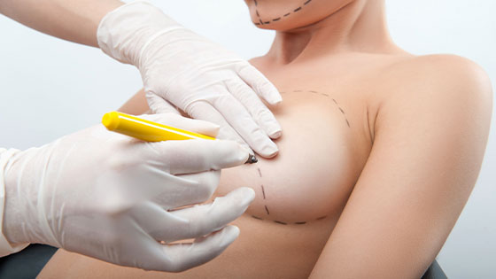 Le lipofilling des seins : une alternative intéressante aux implants mammaires